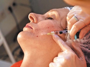 Армирование золотыми нитями в косметологии, что это такое