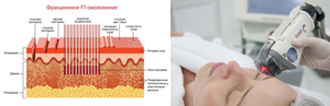 Фракционный термолиз &mdash; метод лазерного омоложения кожи