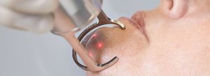 Фракционный термолиз &mdash; метод лазерного омоложения кожи