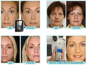 Как эффективно омолодить кожу лица