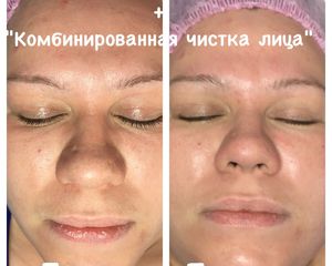 Комбинированная чистка лица: рекомендации и этапы
