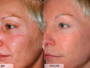 Мануальная чистка лица для красоты кожи