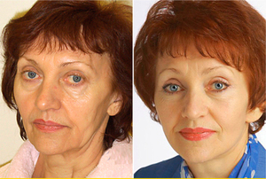 Омоложение лица после 50 лет без операции