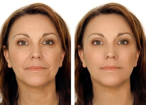 Омоложение лица после 50 лет без операции