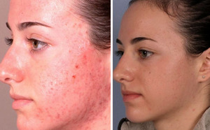 Особенности лазерной и механической дермабразии лица