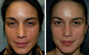 Особенности лазерной и механической дермабразии лица