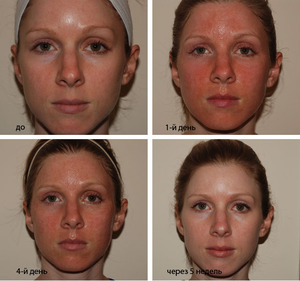 Особенности лазерной и механической дермабразии лица