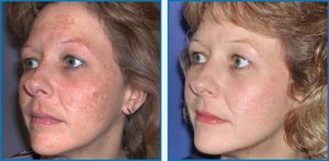 Особенности лазерной и механической дермабразии лица