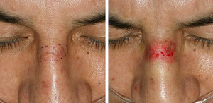 Особенности лазерной и механической дермабразии лица