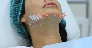 Особенности процедуры тредлифтинга 3Д-мезонитями