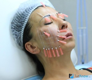 Особенности процедуры тредлифтинга 3Д-мезонитями