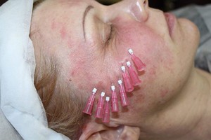 Особенности процедуры тредлифтинга 3Д-мезонитями