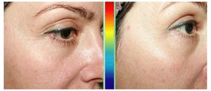 Особенности проведения процедуры фракционного фототермолиза