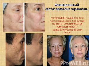 Особенности проведения процедуры фракционного фототермолиза