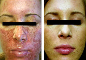 Особенности проведения процедуры фракционного фототермолиза