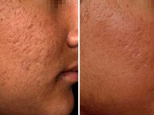 Особенности проведения процедуры фракционного фототермолиза