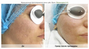 Особенности проведения процедуры фракционного фототермолиза