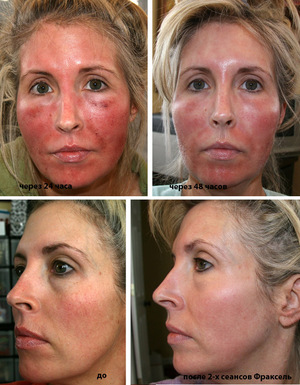 Особенности проведения процедуры фракционного фототермолиза