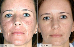 Особенности проведения процедуры фракционного фототермолиза