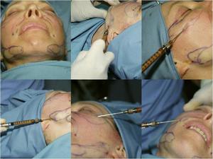 Особенности проведения процедуры липофилинга лица