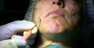 Особенности проведения процедуры липофилинга лица