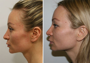 Особенности проведения процедуры липофилинга лица