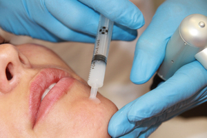 Особенности проведения процедуры микронидлинга