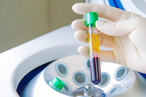 Platelet Rich Plasma: суть ПРП-терапии, проведение процедуры