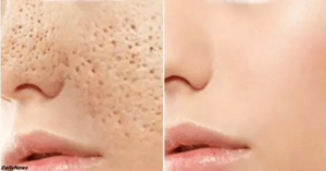 Расширенные поры на лице &mdash; как избавиться