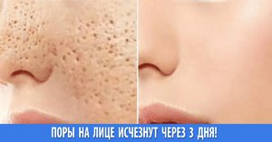 Расширенные поры на лице &mdash; как избавиться