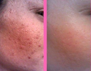 Расширенные поры на лице &mdash; как избавиться