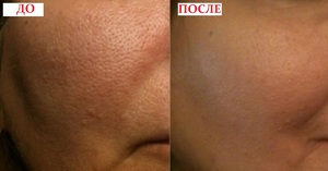 Расширенные поры на лице &mdash; как избавиться