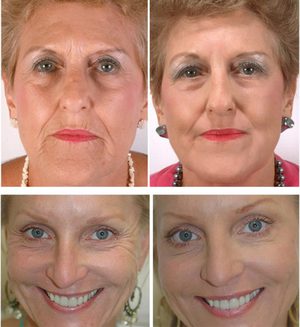 Ревитализация лица &ndash; что это такое