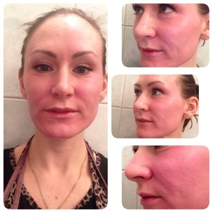 Ревитализация лица &ndash; что это такое