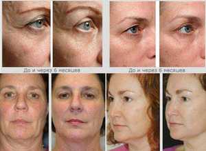 Ревитализация лица &ndash; что это такое