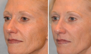 Ревитализация лица &ndash; что это такое