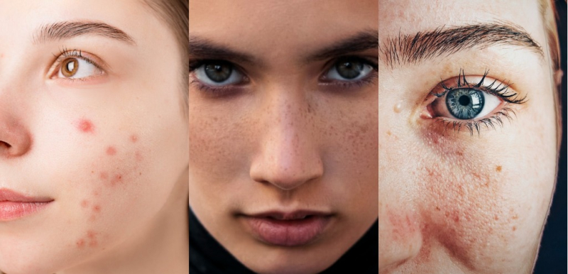 Салициловый пилинг в домашних условиях и у косметолога