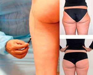Уколы для похудения и сжигания жира на животе