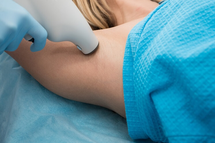 Лазерное лечение гипергидроза особенности